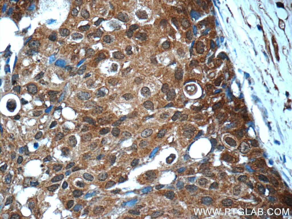 STAT3 Antibody IHC human breast cancer tissue 60199-1-Ig