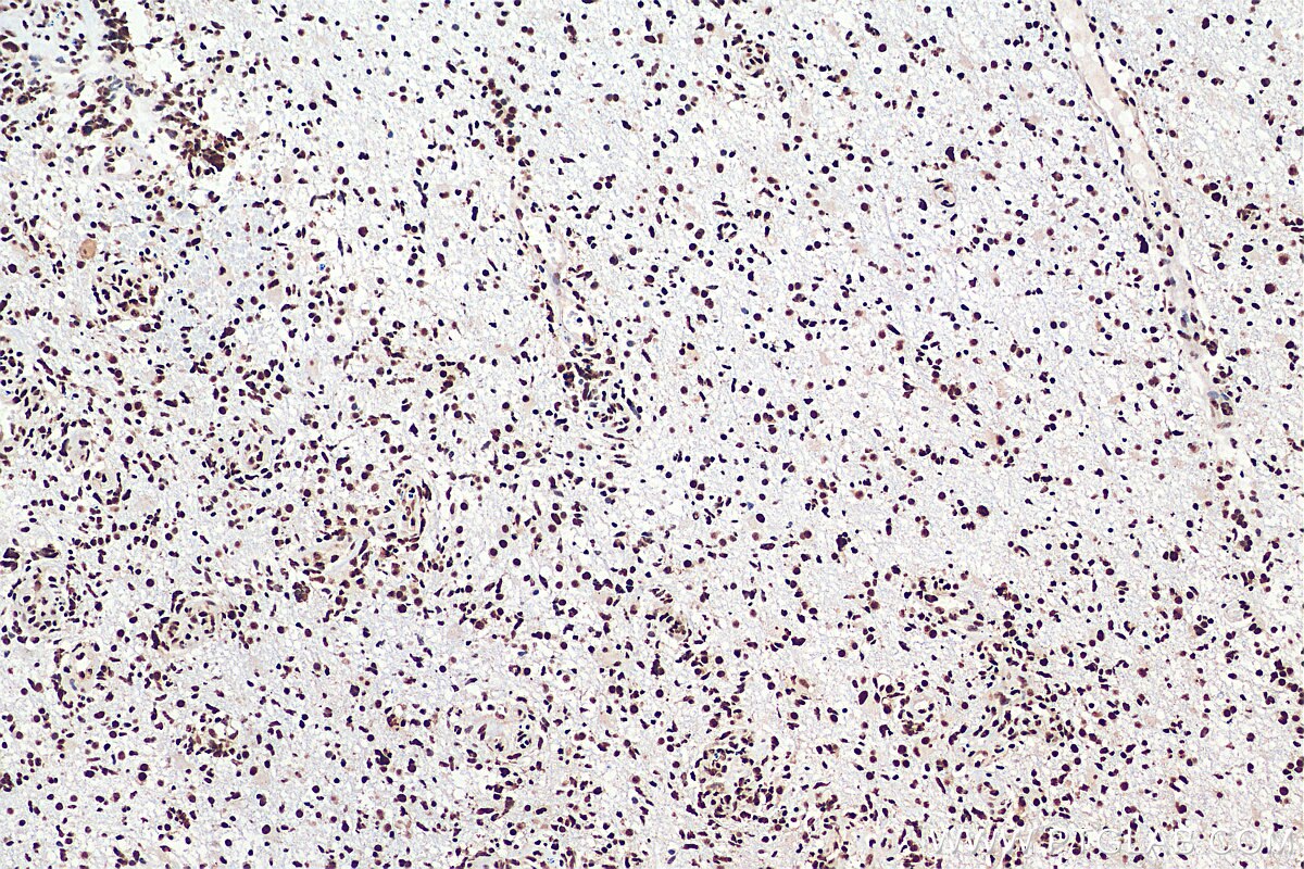 TDP-43 (human specific) Antibody IHC human gliomas tissue 60019-2-Ig