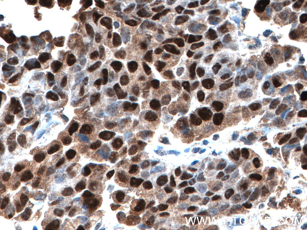 P53 Antibody IHC human prostate cancer tissue 21891-1-AP