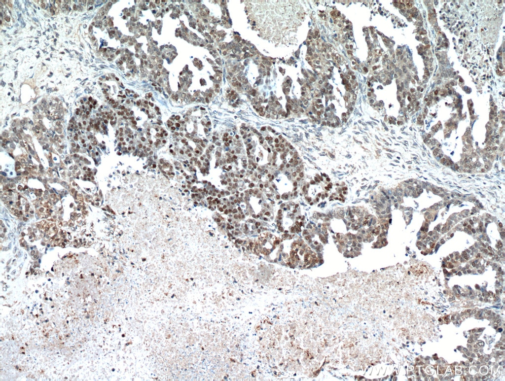 P53 Antibody IHC human ovary tumor tissue 21891-1-AP