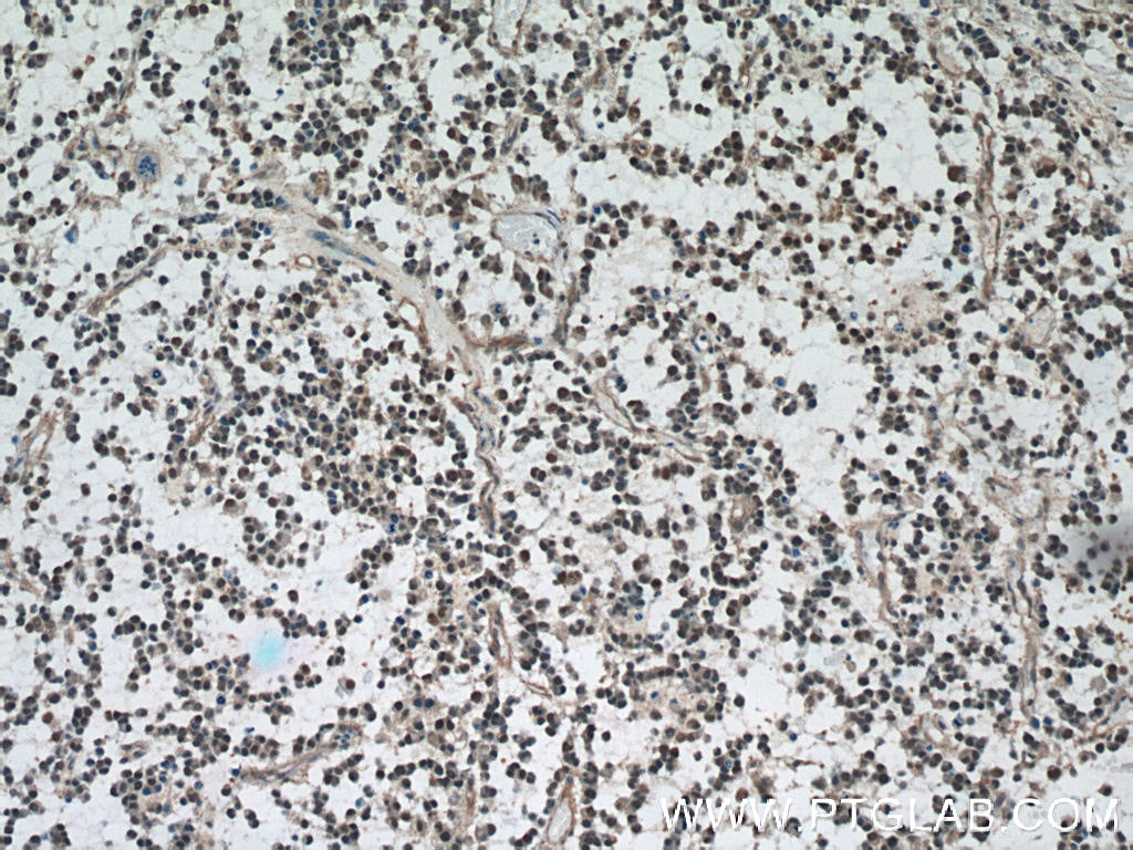 VCP Antibody IHC human gliomas tissue 60316-1-Ig
