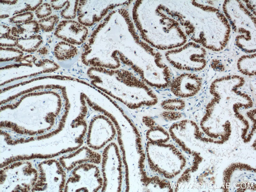 Immunohistochemical analysis of paraffin-embedded human ovary tumor tissue slide using 10336-1-AP (PAX8 Antibody) at dilution of 1:1200 (under 10x lens). Heat mediated antigen retrieval with Tris-EDTA buffer (pH 9.0).