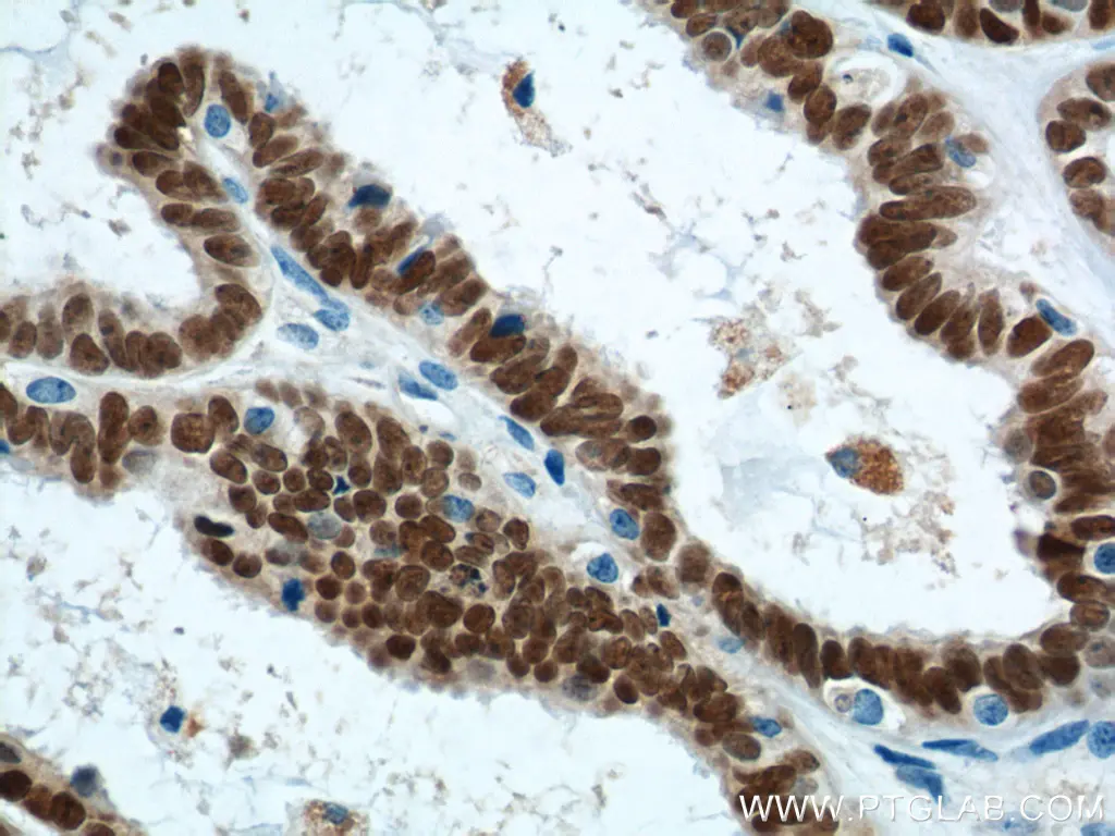 Immunohistochemical analysis of paraffin-embedded human ovary tumor tissue slide using 10336-1-AP (PAX8 Antibody) at dilution of 1:1200 (under 40x lens). Heat mediated antigen retrieval with Tris-EDTA buffer (pH 9.0).