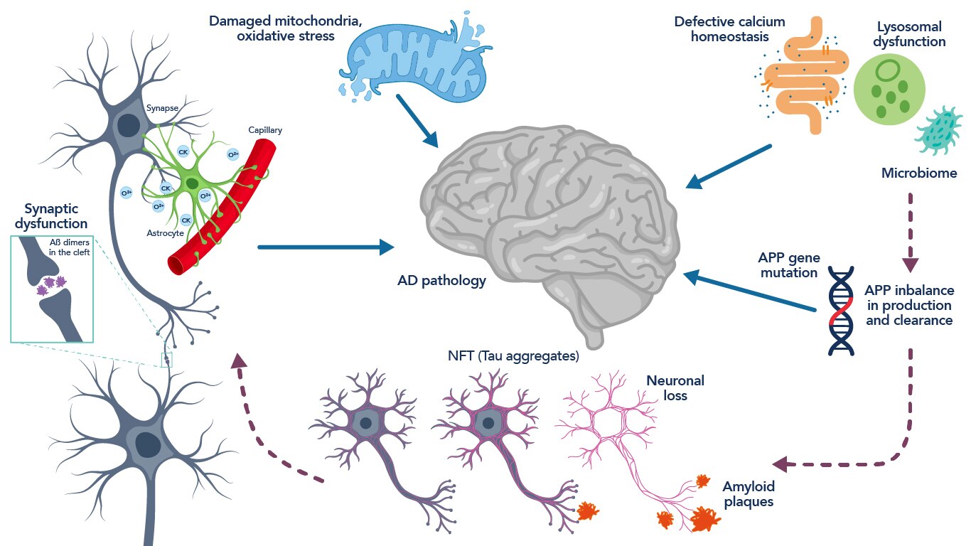 Schematic representation of the neuropathology and pathophysiology associated with Alzheimer’s disease