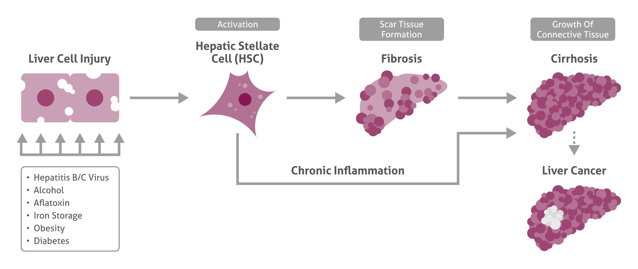 diagram of pathogenesis of liver cancer