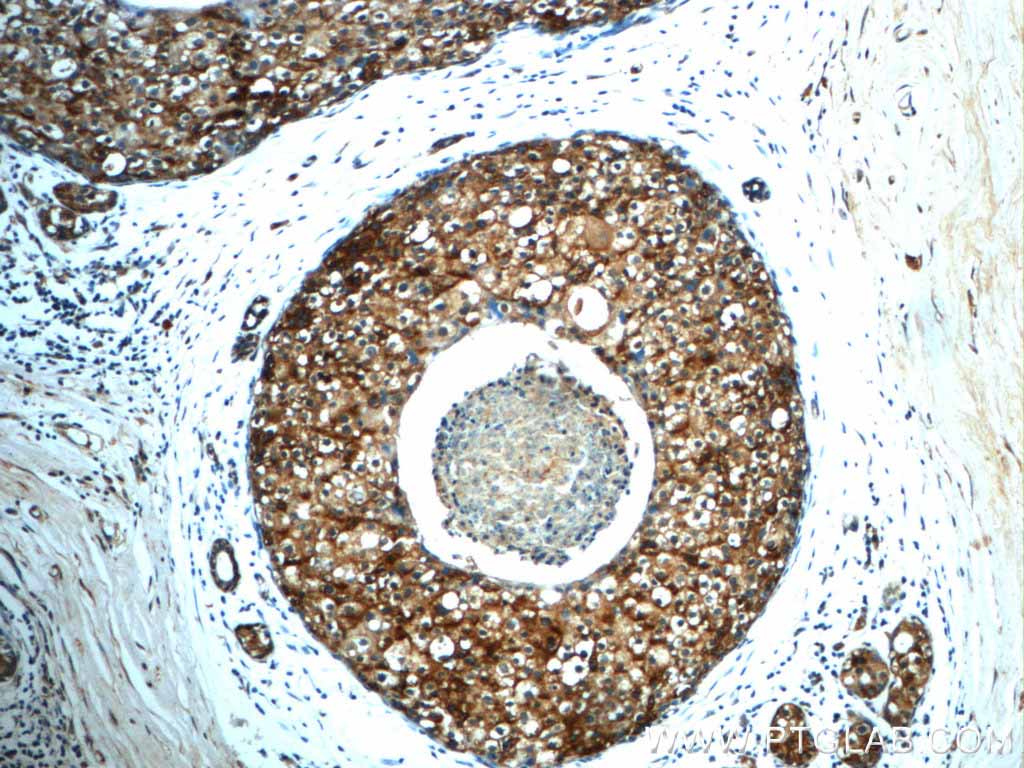 Immunohistochemistry of paraffin-embedded human breast cancer slide using 20597-1-AP( CD9 Antibody) at dilution of 1:50