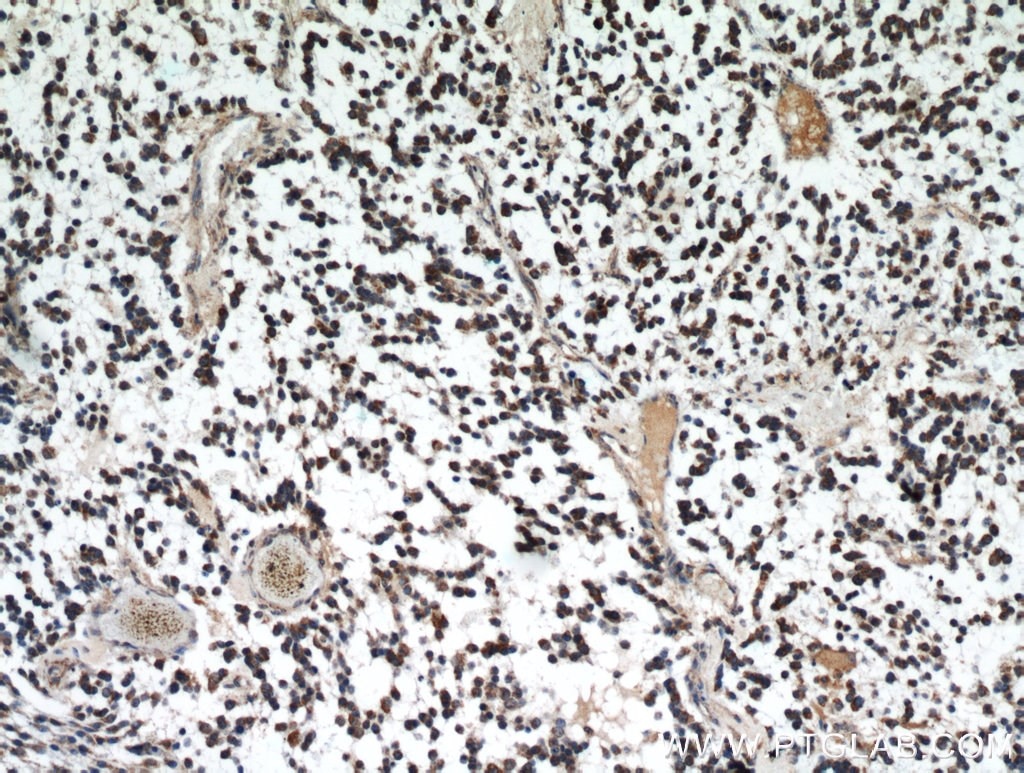 IDH1抗体を使用したパラフィン包埋ヒト神経膠腫の免疫組織化学染色