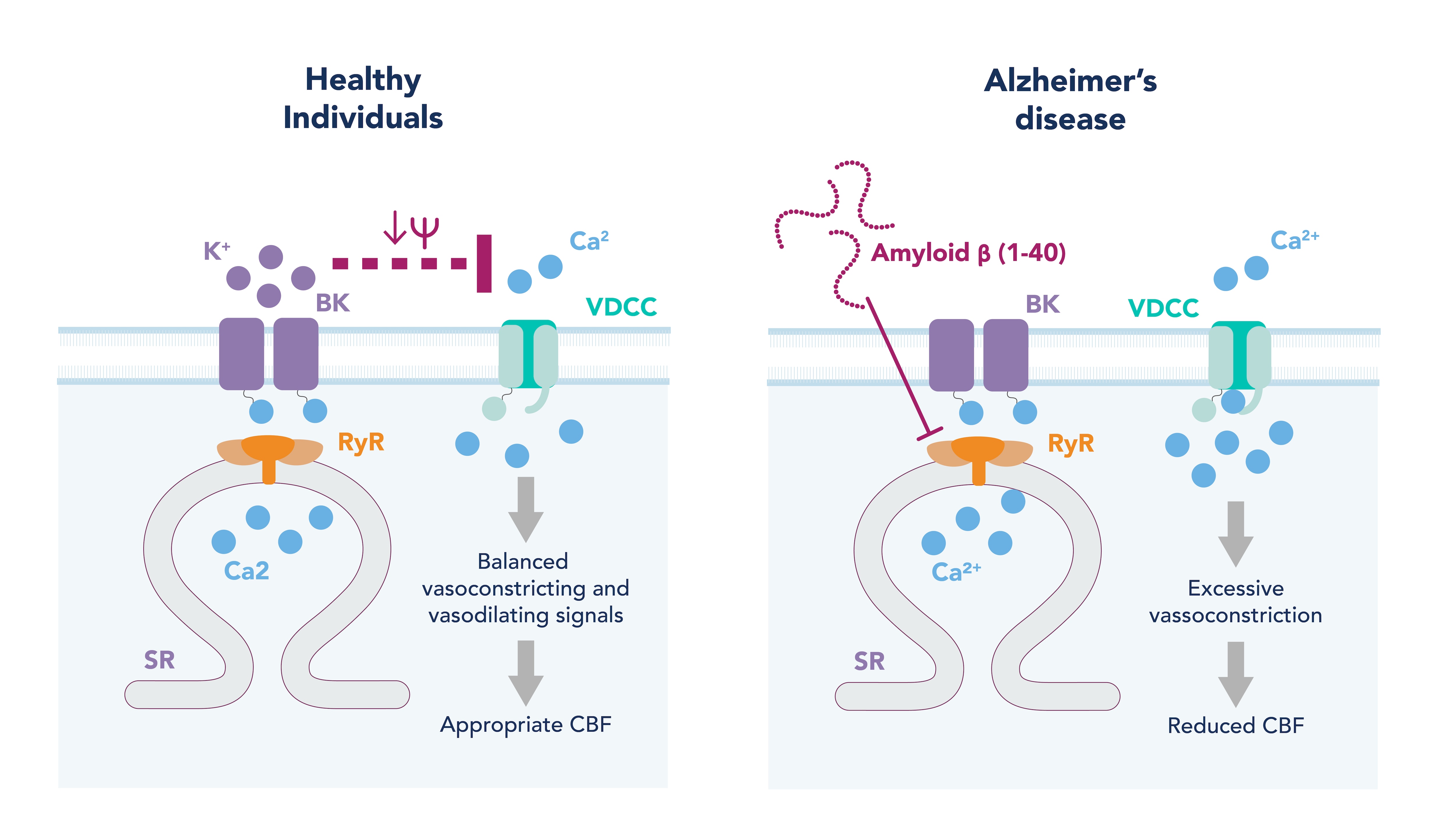 Graphic detailing overview of how cerebral vascular arteries response to increased luminal pressure in healthy vs Alzheimers disease.
