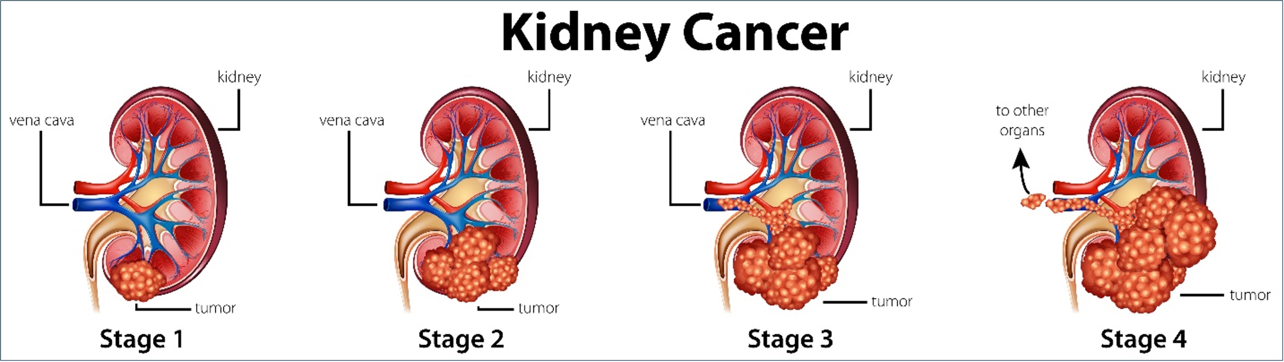 Diagram showing different stages of kidney cancer