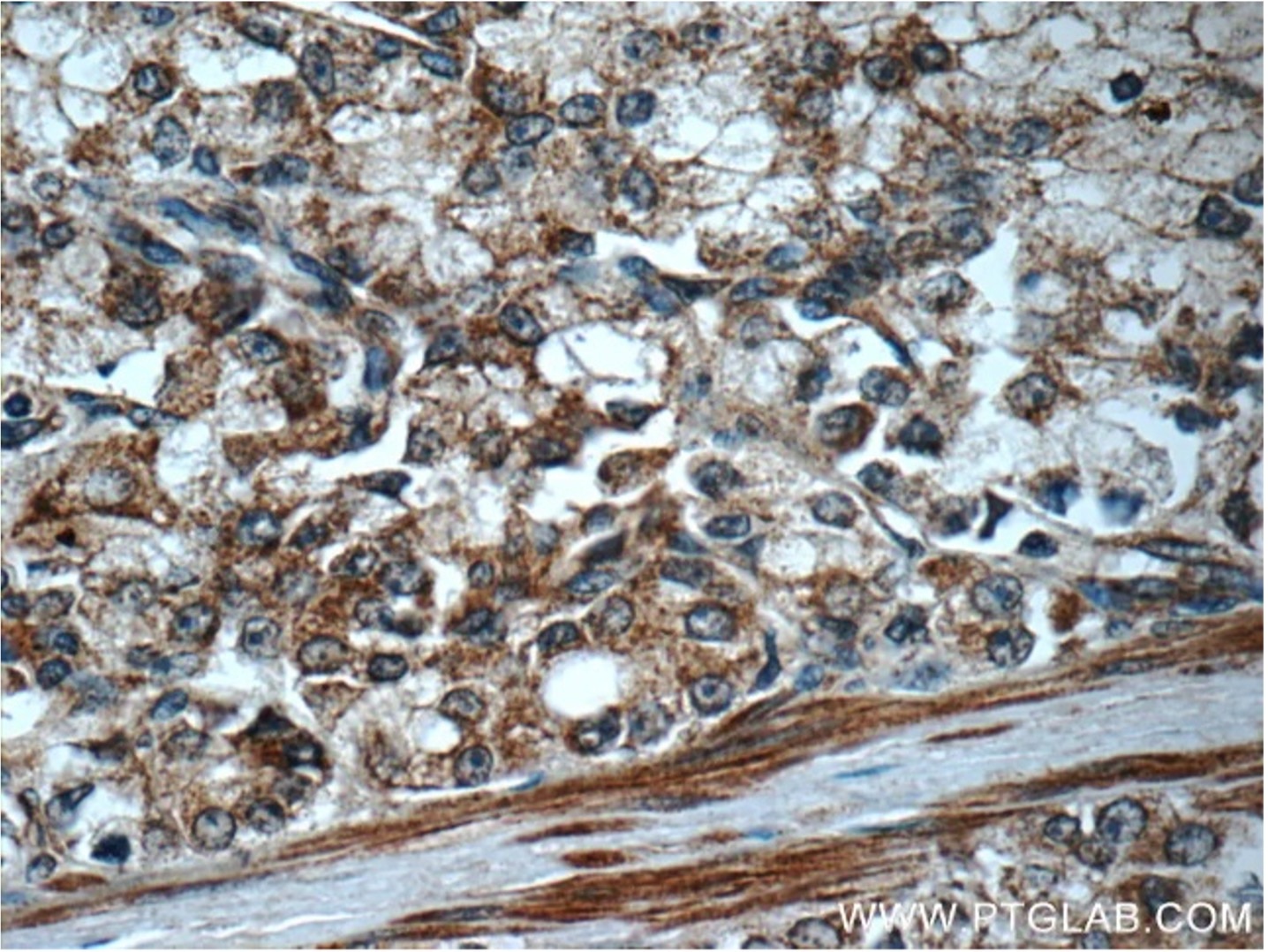 Immunohistochemistry of human prostate cancer tissue using FAS antibody from Proteintech