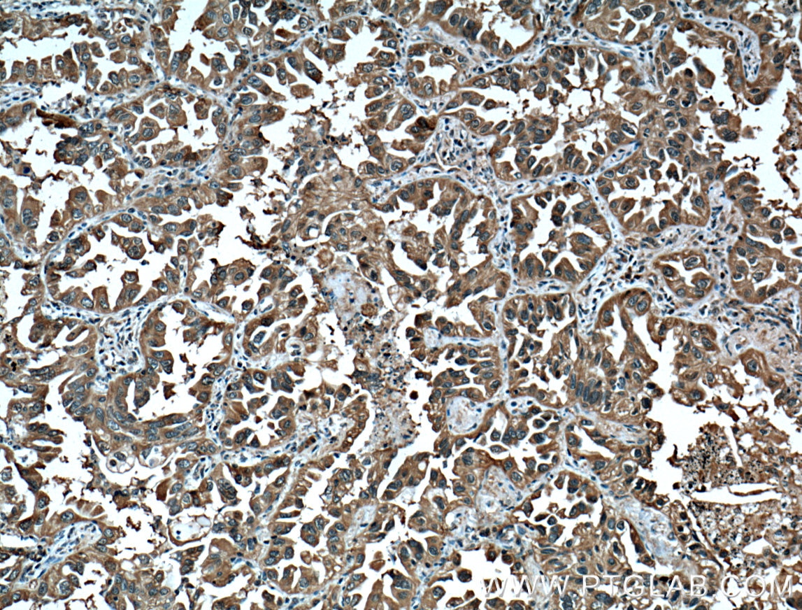 IHC staining of human lung cancer using 66061-1-Ig