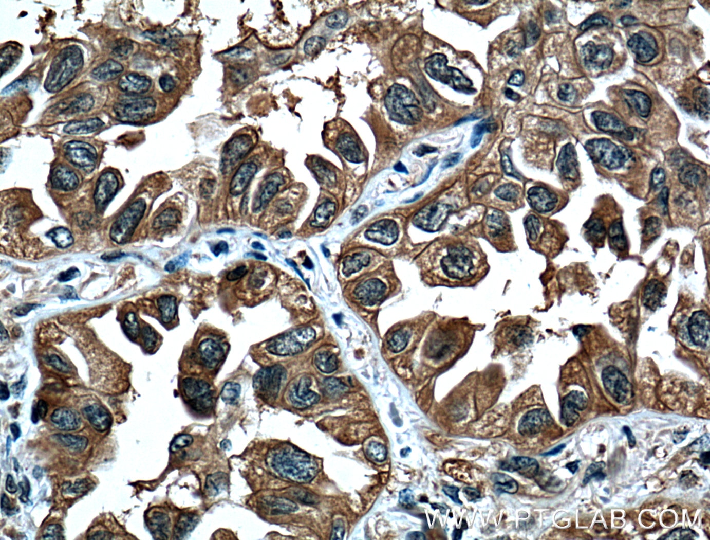 Immunohistochemistry (IHC) staining of human lung cancer tissue using 14-3-3 Monoclonal antibody (66061-1-Ig)