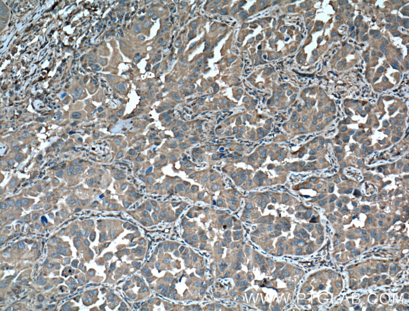 Immunohistochemistry (IHC) staining of human lung cancer tissue using 14-3-3 Epsilon Polyclonal antibody (11648-2-AP)