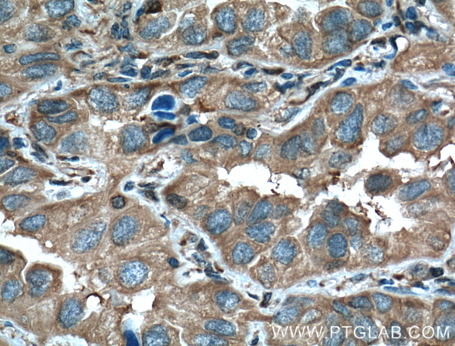 Immunohistochemistry (IHC) staining of human lung cancer tissue using 14-3-3 Epsilon Polyclonal antibody (11648-2-AP)