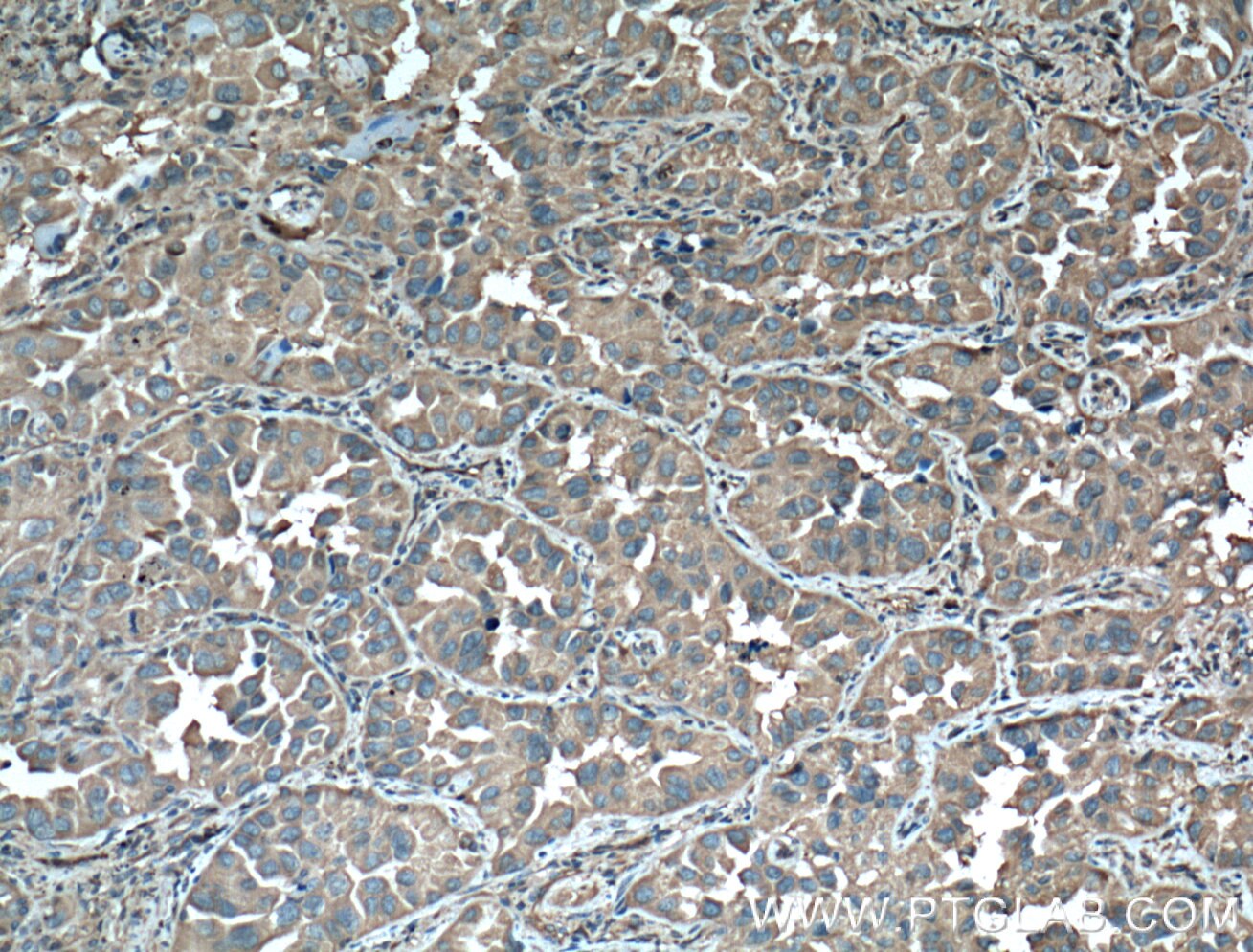 Immunohistochemistry (IHC) staining of human lung cancer tissue using 14-3-3 Epsilon Polyclonal antibody (11648-2-AP)