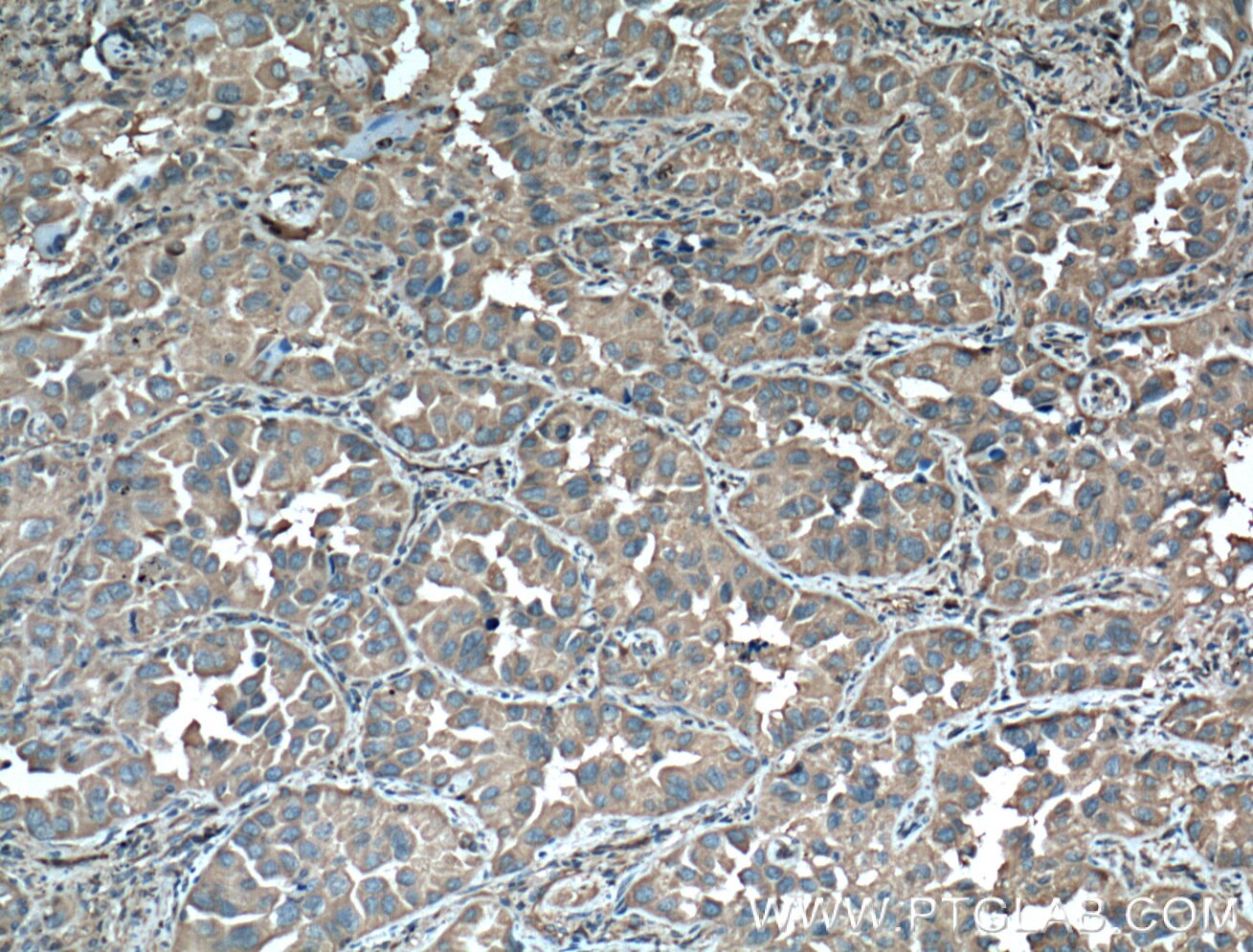 IHC staining of human lung cancer using 11648-2-AP