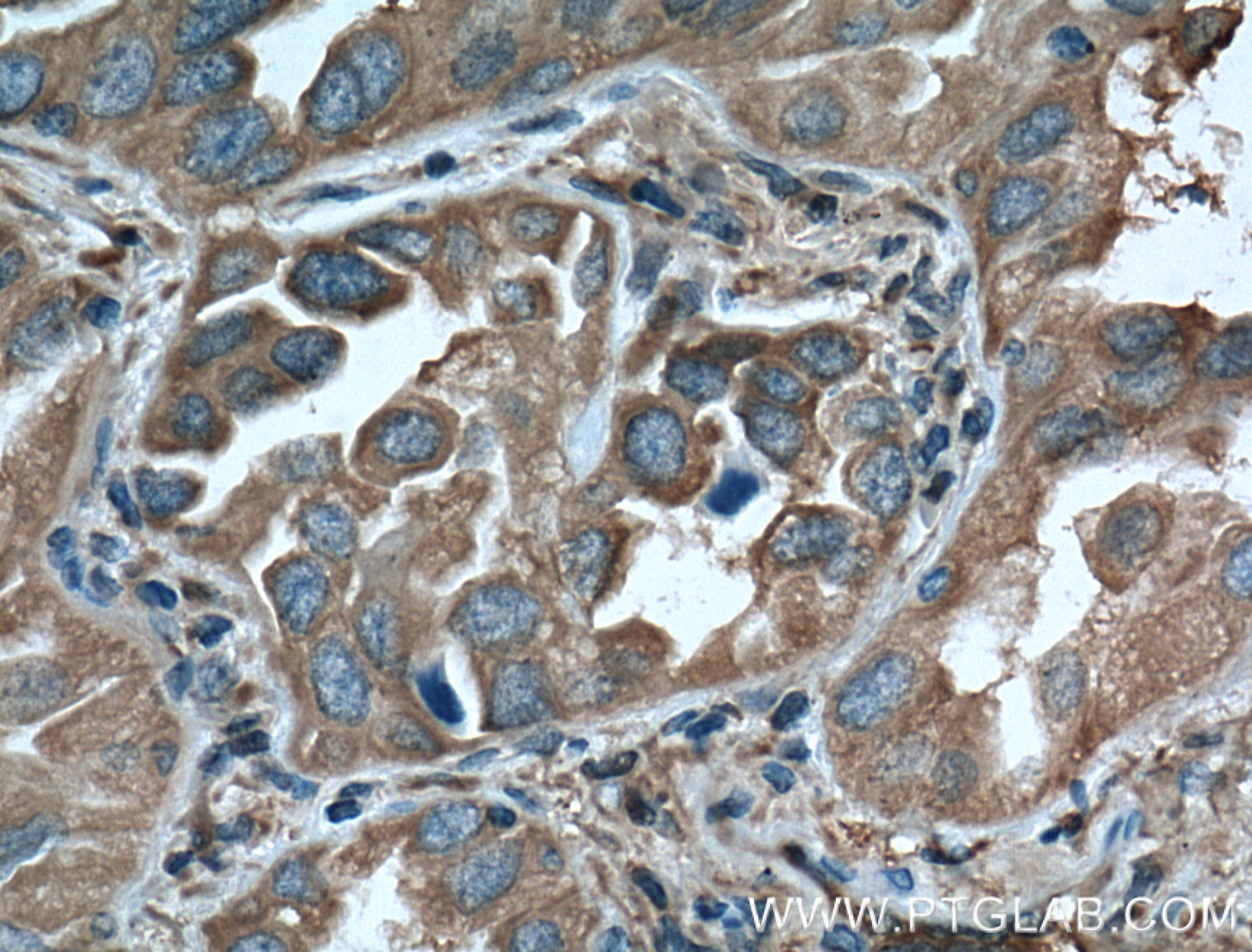 Immunohistochemistry (IHC) staining of human lung cancer tissue using 14-3-3 Epsilon Polyclonal antibody (11648-2-AP)