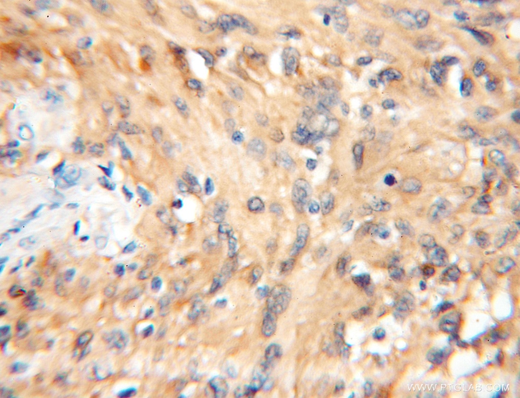 Immunohistochemistry (IHC) staining of human gliomas tissue using 14-3-3 Epsilon Polyclonal antibody (11648-2-AP)
