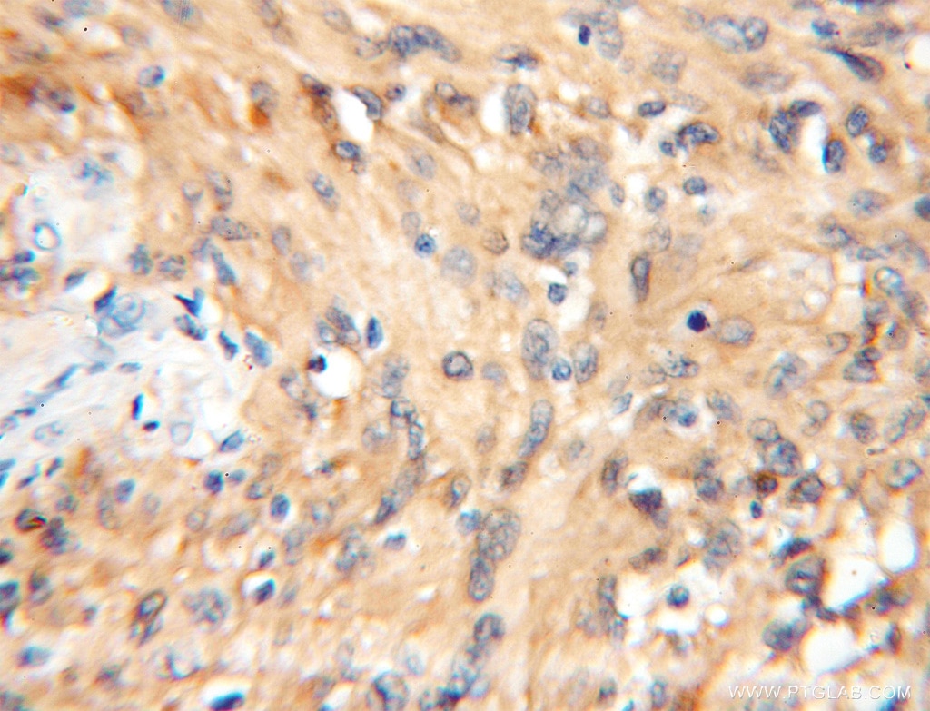 IHC staining of human gliomas using 11648-2-AP