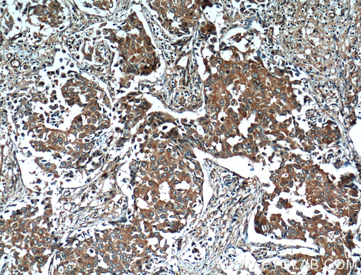 Immunohistochemistry (IHC) staining of human breast cancer tissue using 14-3-3 GAMMA-Specific Polyclonal antibody (12381-1-AP)
