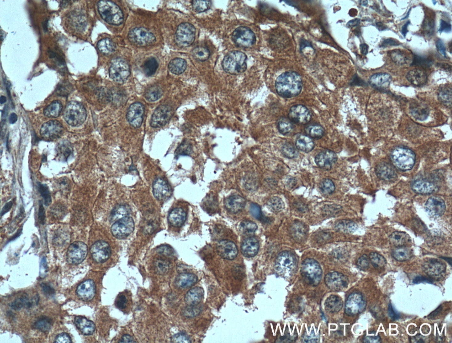 Immunohistochemistry (IHC) staining of human breast cancer tissue using 14-3-3 GAMMA-Specific Polyclonal antibody (12381-1-AP)