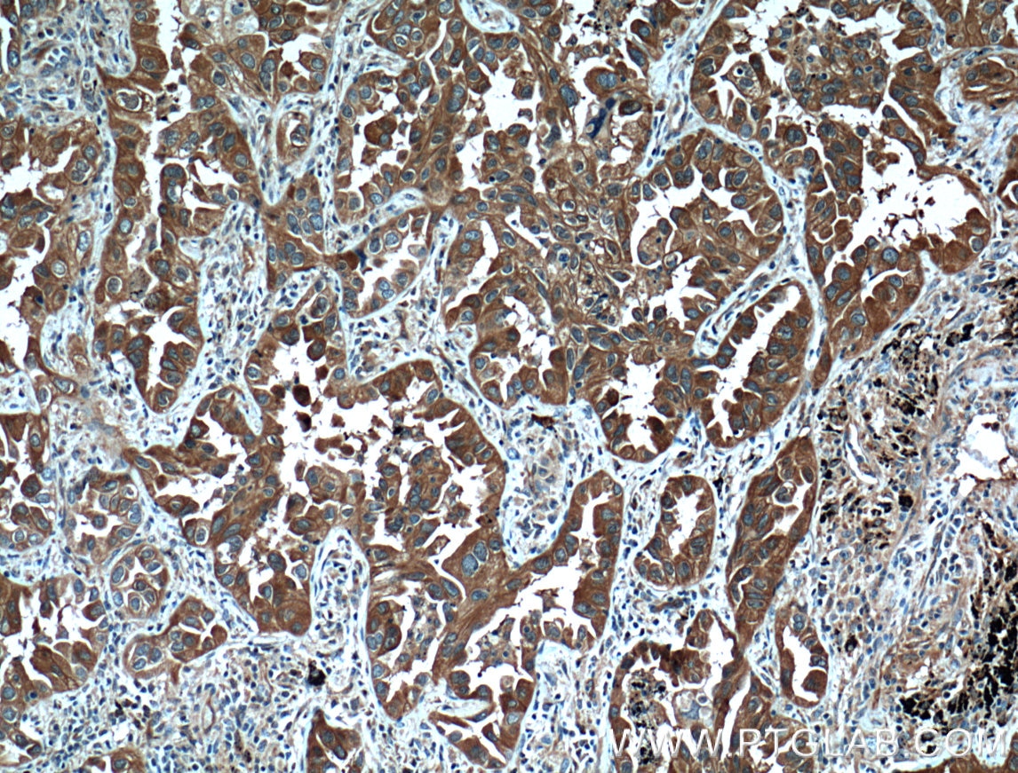 IHC staining of human lung cancer using 12381-1-AP