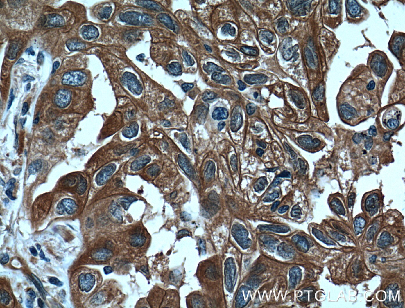 IHC staining of human lung cancer using 12381-1-AP