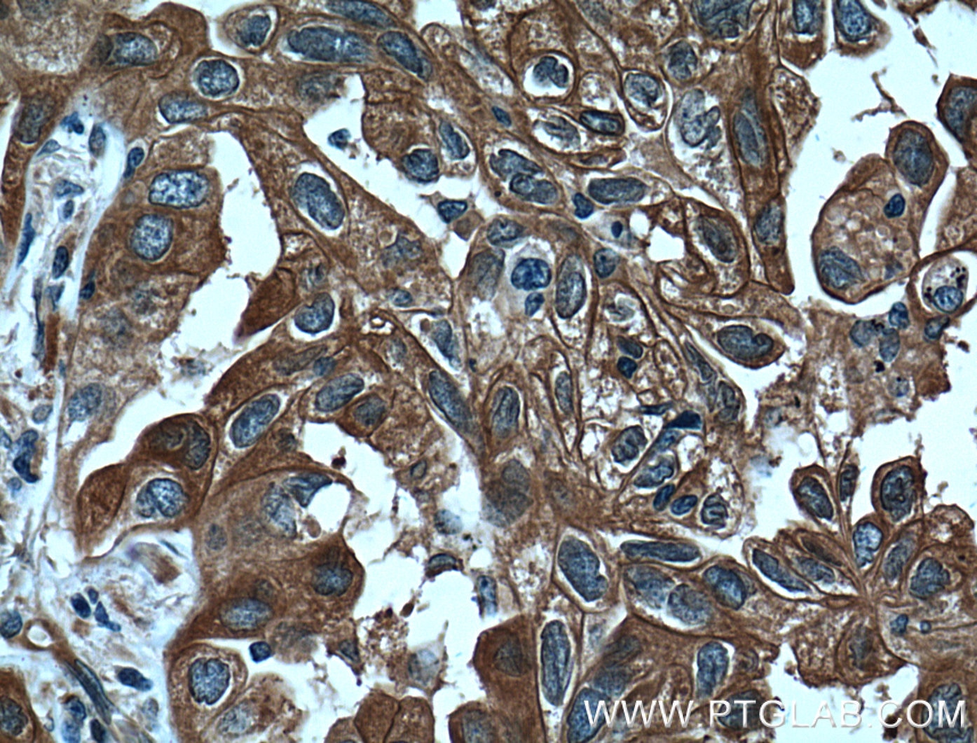 Immunohistochemistry (IHC) staining of human lung cancer tissue using 14-3-3 GAMMA-Specific Polyclonal antibody (12381-1-AP)