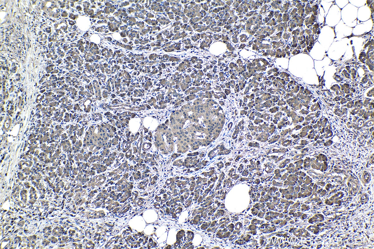 Immunohistochemistry (IHC) staining of human pancreas cancer tissue using 4EBP1 Monoclonal antibody (60246-1-Ig)