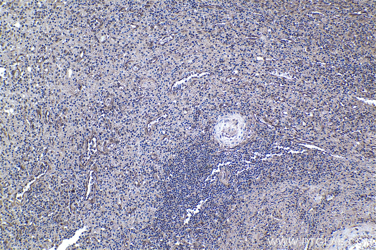 Immunohistochemistry (IHC) staining of human colon cancer tissue using 4EBP1 Monoclonal antibody (60246-1-Ig)