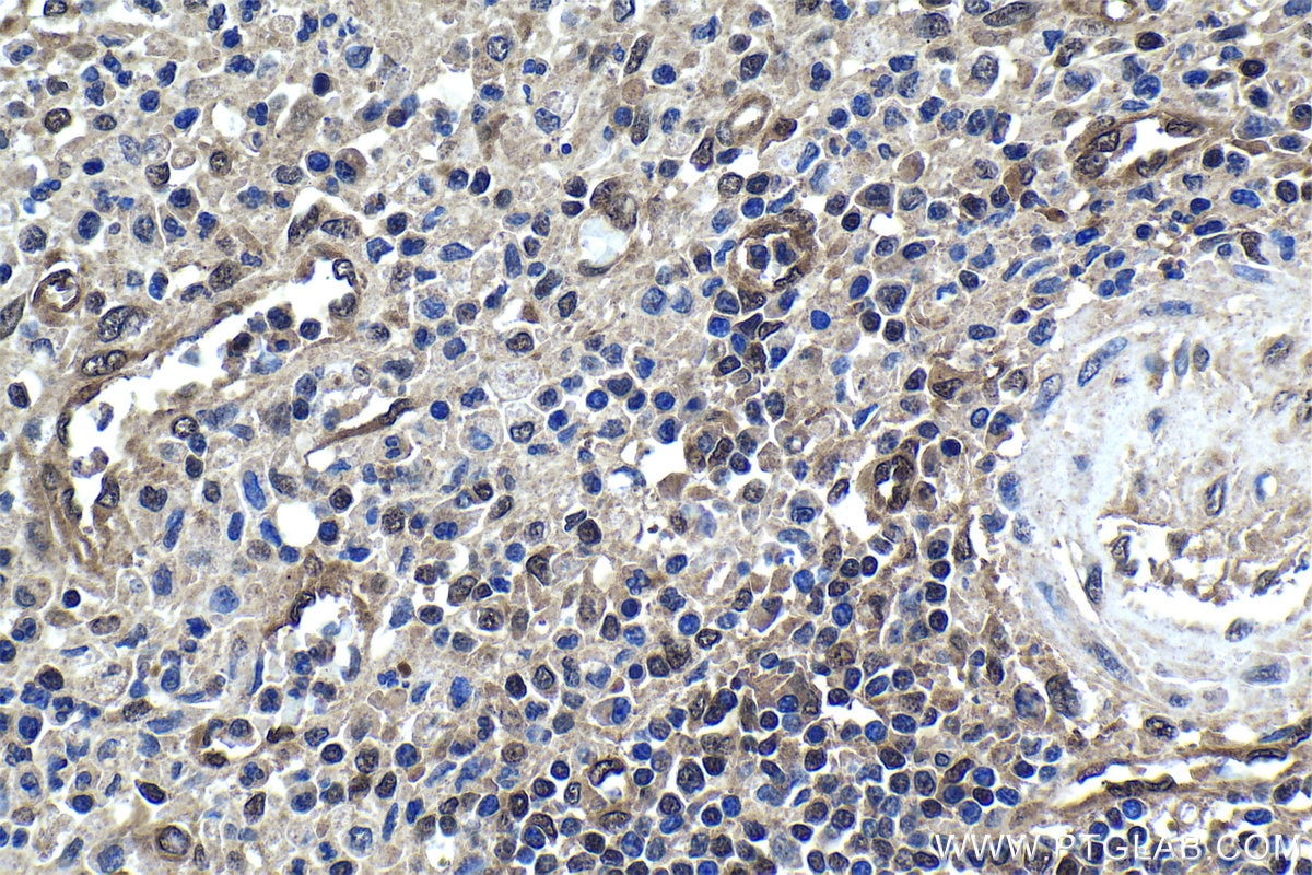 Immunohistochemistry (IHC) staining of human colon cancer tissue using 4EBP1 Monoclonal antibody (60246-1-Ig)