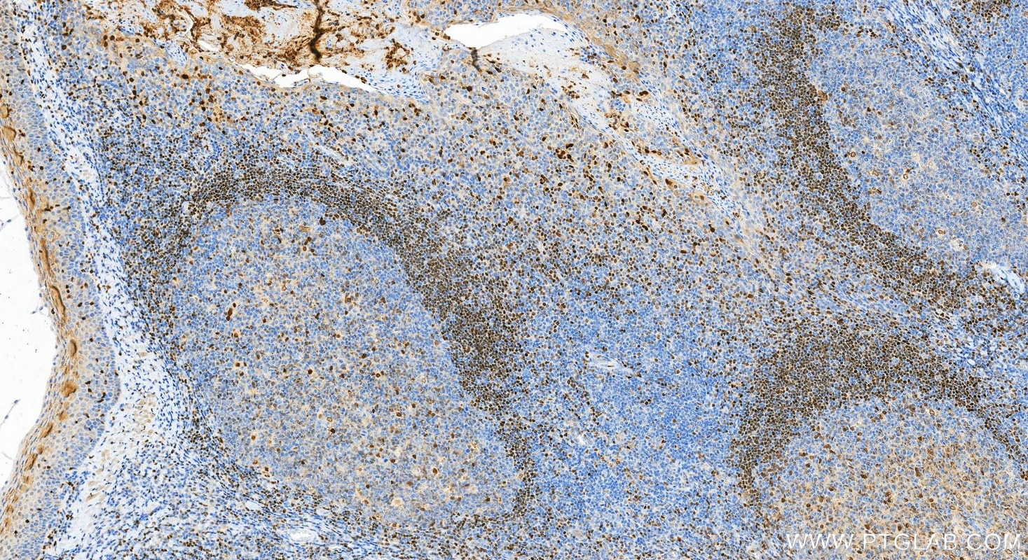 Immunohistochemistry (IHC) staining of human tonsillitis tissue using Multi-rAb® 5 Lipoxygenase Multi-Recombinant antibo (RMX00080)