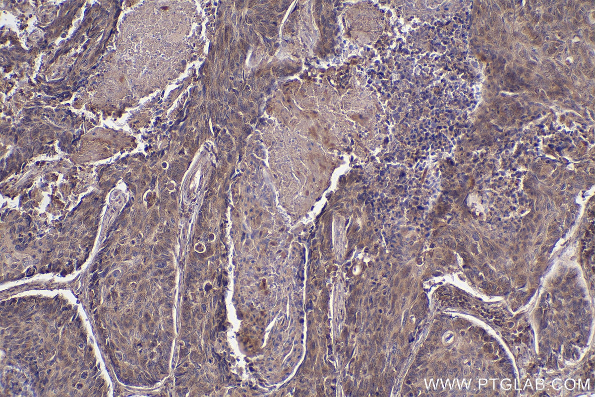 Immunohistochemistry (IHC) staining of human lung cancer tissue using 53BP2 Polyclonal antibody (26550-1-AP)