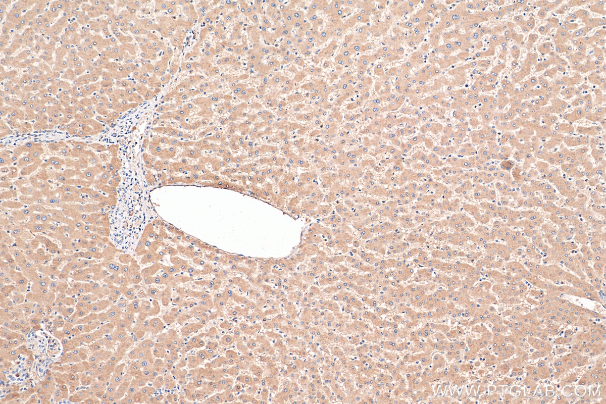 Immunohistochemistry (IHC) staining of human hepatocirrhosis tissue using Alpha 1B-Glycoprotein Polyclonal antibody (14181-1-AP)