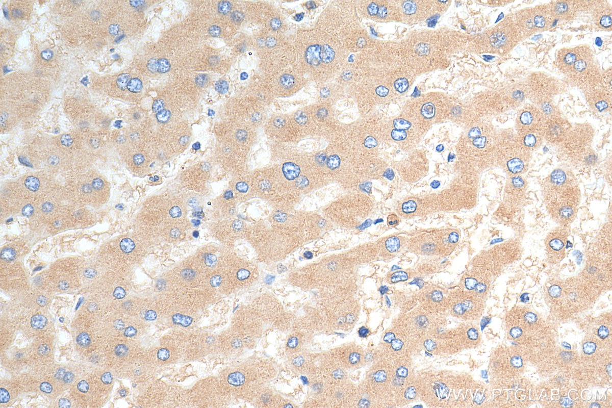 Immunohistochemistry (IHC) staining of human hepatocirrhosis tissue using Alpha 1B-Glycoprotein Polyclonal antibody (14181-1-AP)