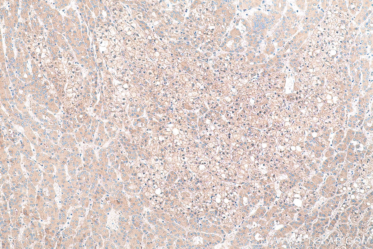 Immunohistochemistry (IHC) staining of human liver cancer tissue using Alpha-2-Macroglobulin Monoclonal antibody (66126-1-Ig)