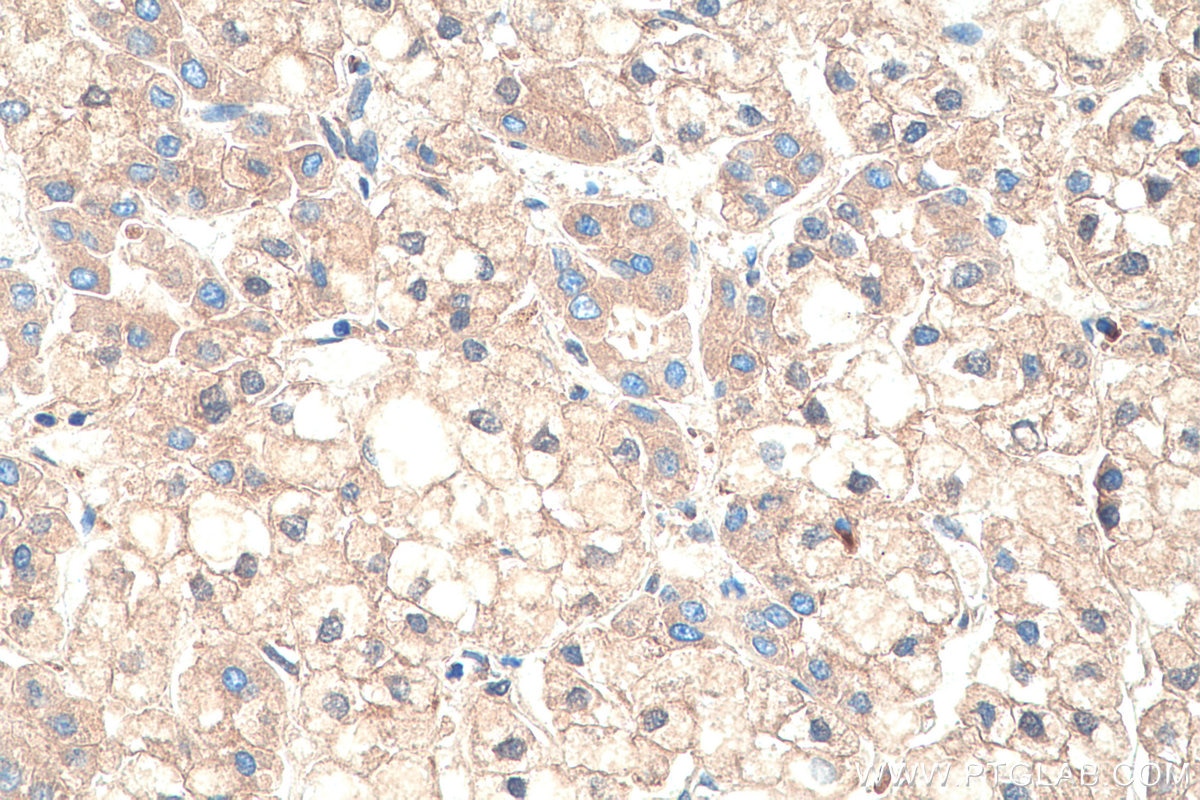 Immunohistochemistry (IHC) staining of human liver cancer tissue using Alpha-2-Macroglobulin Monoclonal antibody (66126-1-Ig)