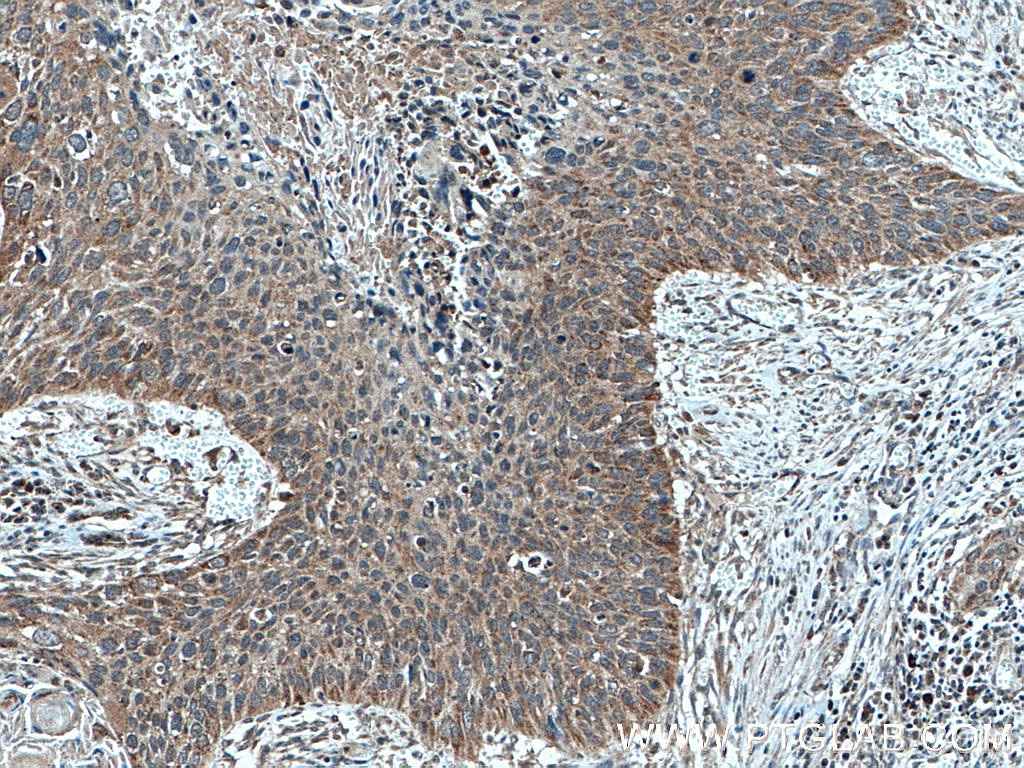 IHC staining of human cervical cancer using 12392-1-AP
