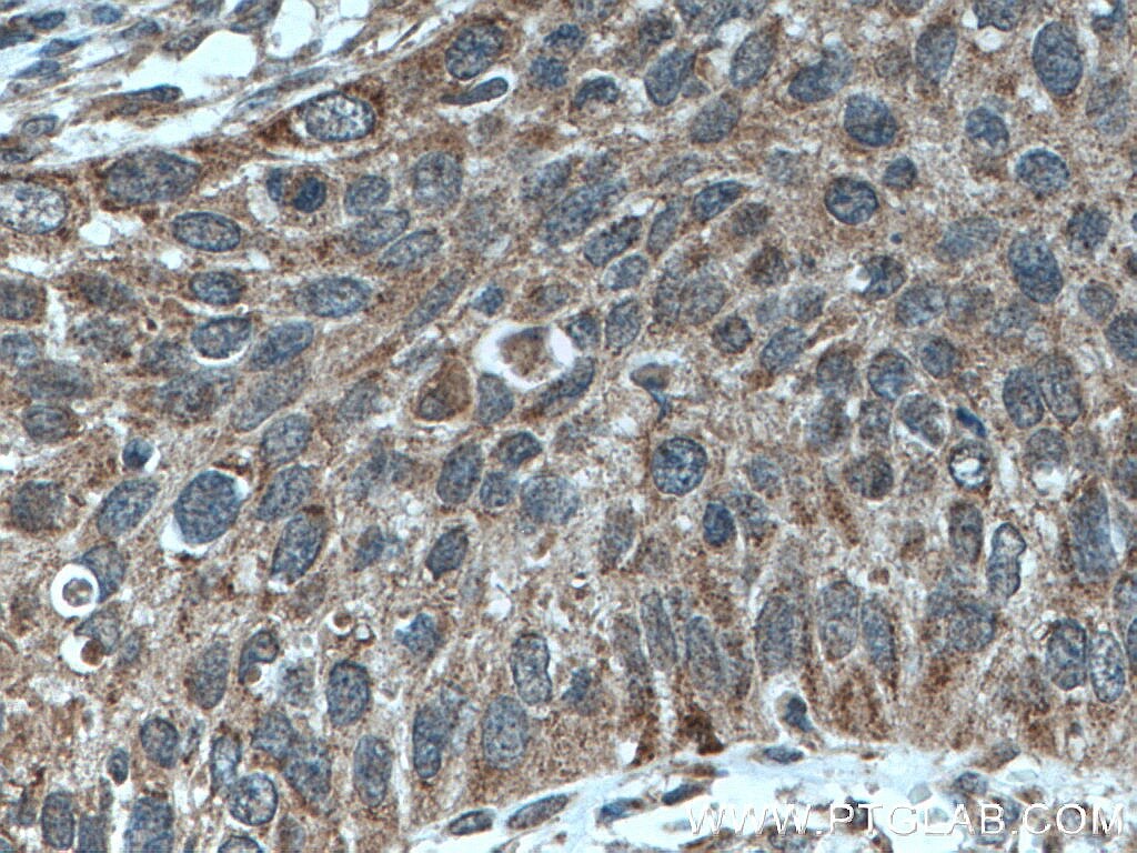 Immunohistochemistry (IHC) staining of human cervical cancer tissue using A4GALT Polyclonal antibody (12392-1-AP)