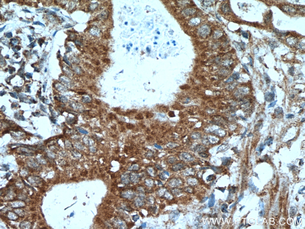 Immunohistochemistry (IHC) staining of human stomach cancer tissue using A4GNT Polyclonal antibody (22670-1-AP)