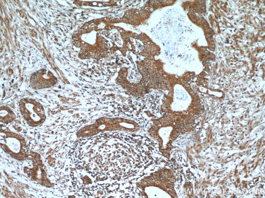 Immunohistochemistry (IHC) staining of human stomach cancer tissue using A4GNT Polyclonal antibody (22670-1-AP)