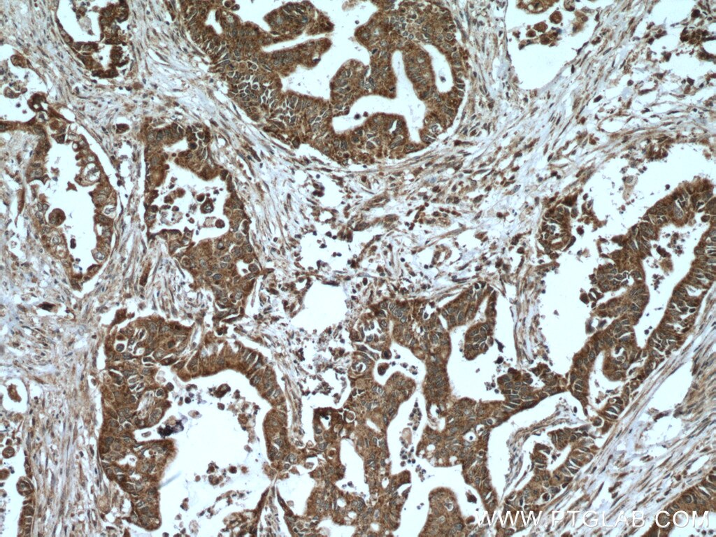 Immunohistochemistry (IHC) staining of human pancreas cancer tissue using A4GNT Polyclonal antibody (22670-1-AP)