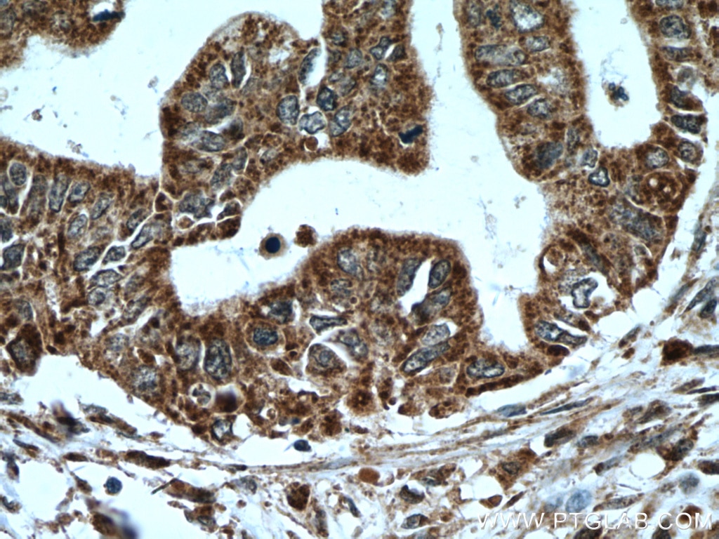 IHC staining of human pancreas cancer using 22670-1-AP