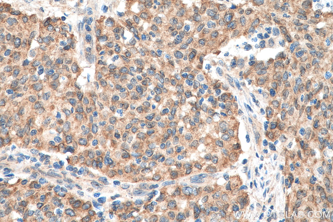 Immunohistochemistry (IHC) staining of human stomach cancer tissue using ALADIN Polyclonal antibody (15127-1-AP)
