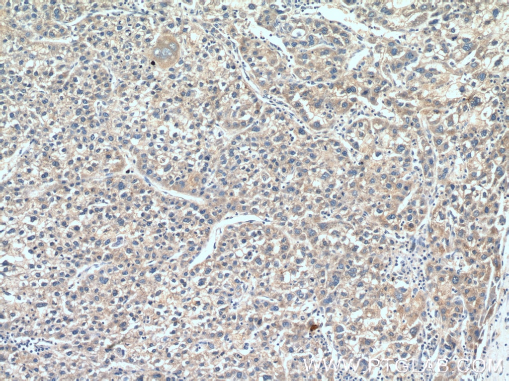 Immunohistochemistry (IHC) staining of human liver cancer tissue using AADAC Polyclonal antibody (26634-1-AP)