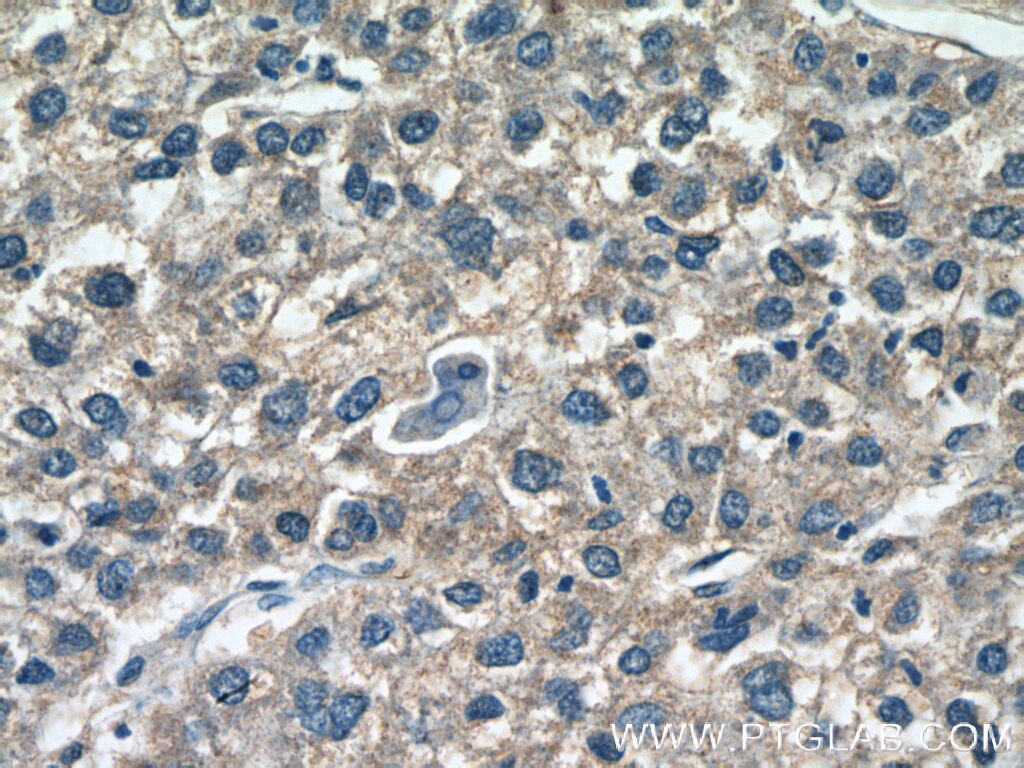 Immunohistochemistry (IHC) staining of human liver cancer tissue using AADAC Polyclonal antibody (26634-1-AP)