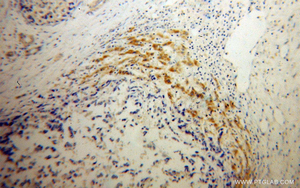 Immunohistochemistry (IHC) staining of human liver cancer tissue using AADAT Polyclonal antibody (13031-1-AP)