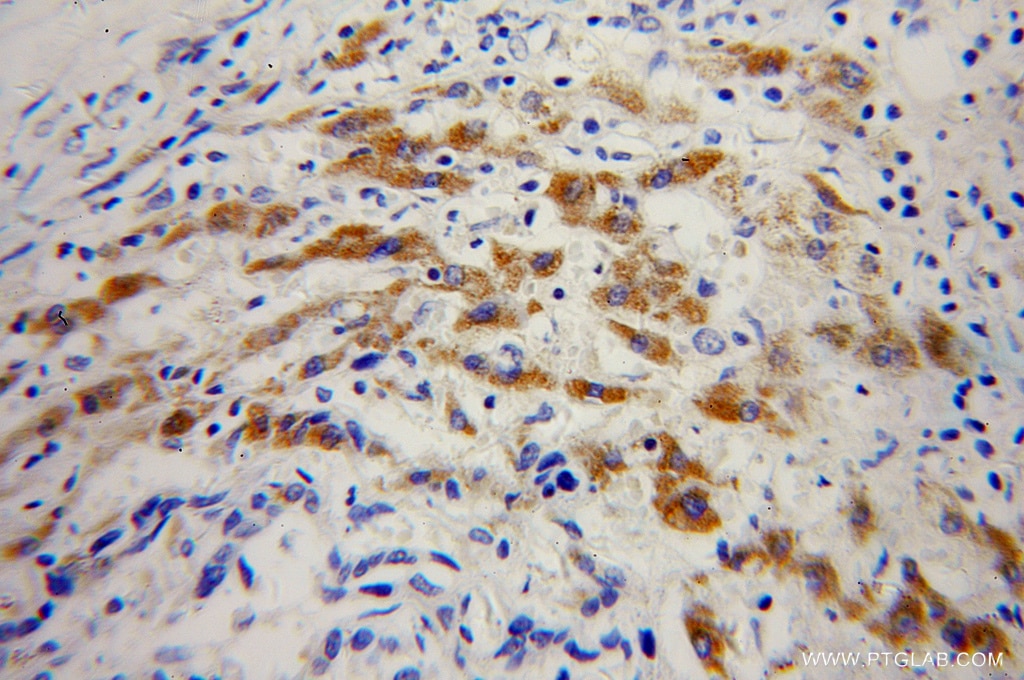 Immunohistochemistry (IHC) staining of human liver cancer tissue using AADAT Polyclonal antibody (13031-1-AP)