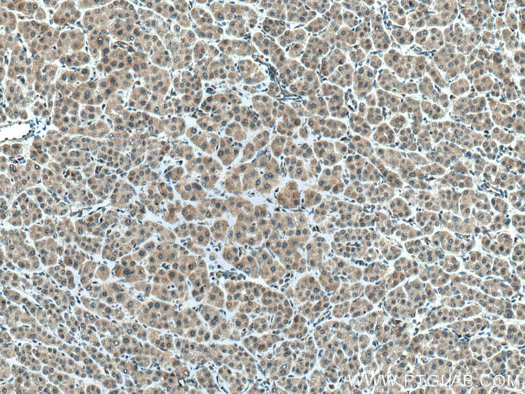 Immunohistochemistry (IHC) staining of human liver cancer tissue using AAMP Polyclonal antibody (21220-1-AP)