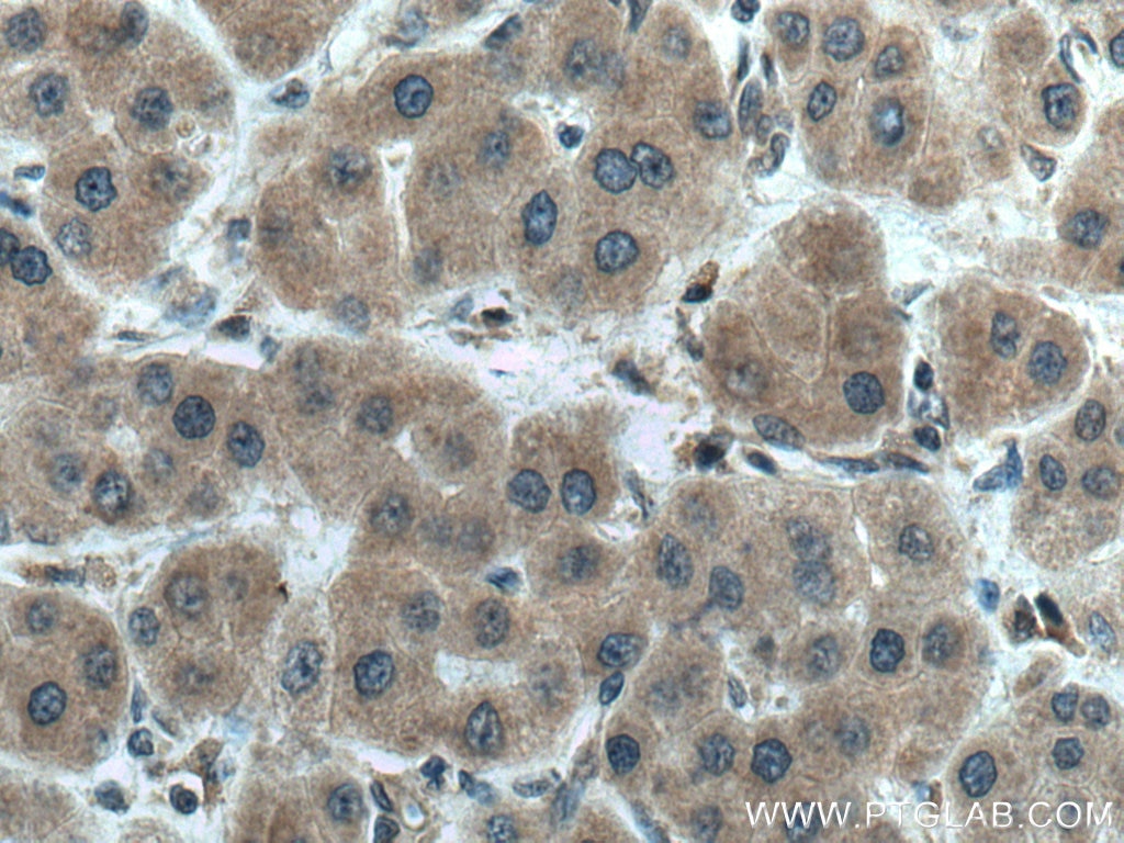 Immunohistochemistry (IHC) staining of human liver cancer tissue using AAMP Polyclonal antibody (21220-1-AP)